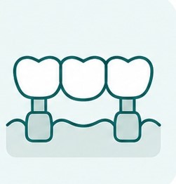 Puentes fijos y removibles